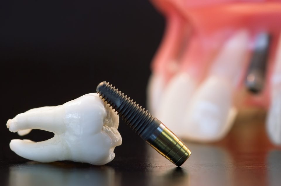 L’implantologia Dentale